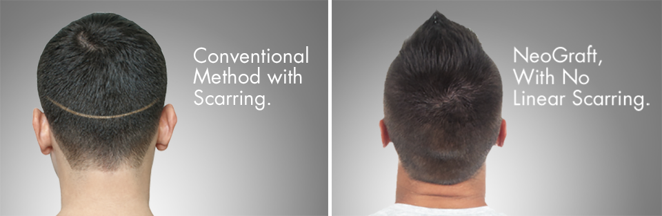 Hair Restoration Chicago | Neograft Wicker Park | Hair Transplantation Evanston, IL Hair Restoration Chicago | Neograft Wicker Park | Hair Transplantation Evanston, IL