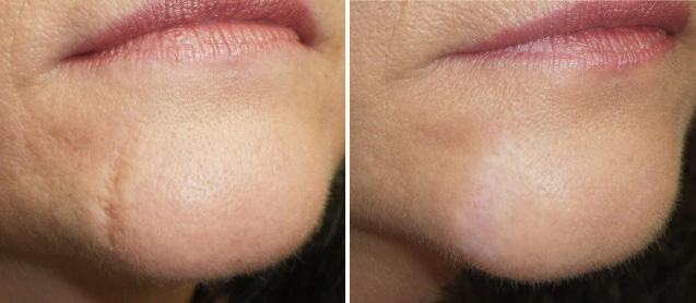 Laser for scars discount