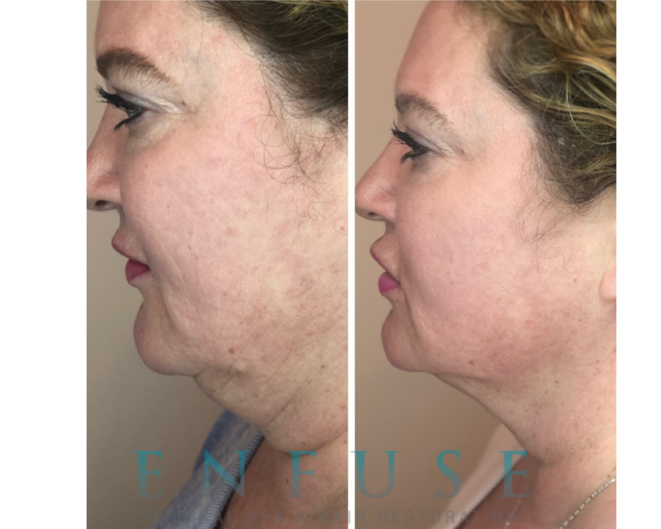 Kybella Before & After