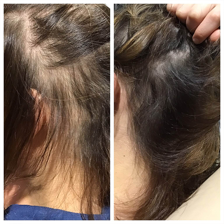 PRP Hair Restoration Chicago | Hair Loss Treatment Wicker Park, IL