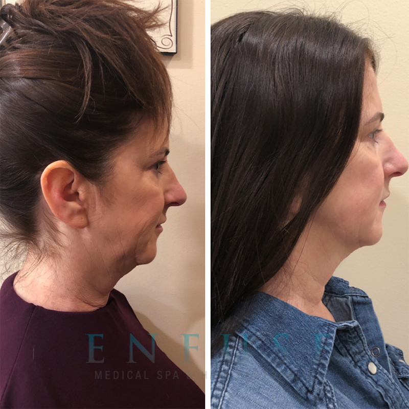  Laser Skin Rejuvenation before and after result