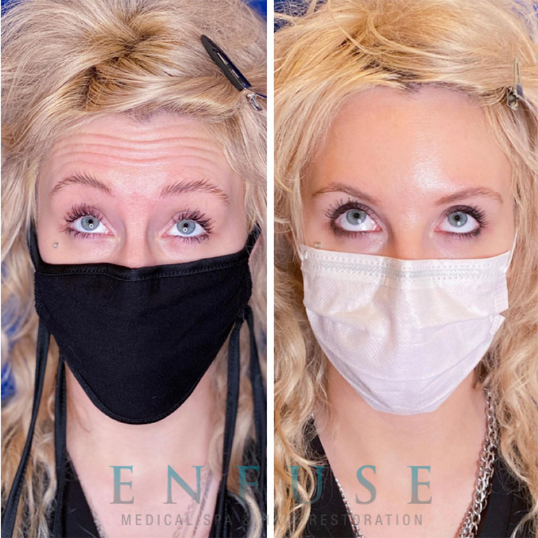 Botox Before and After