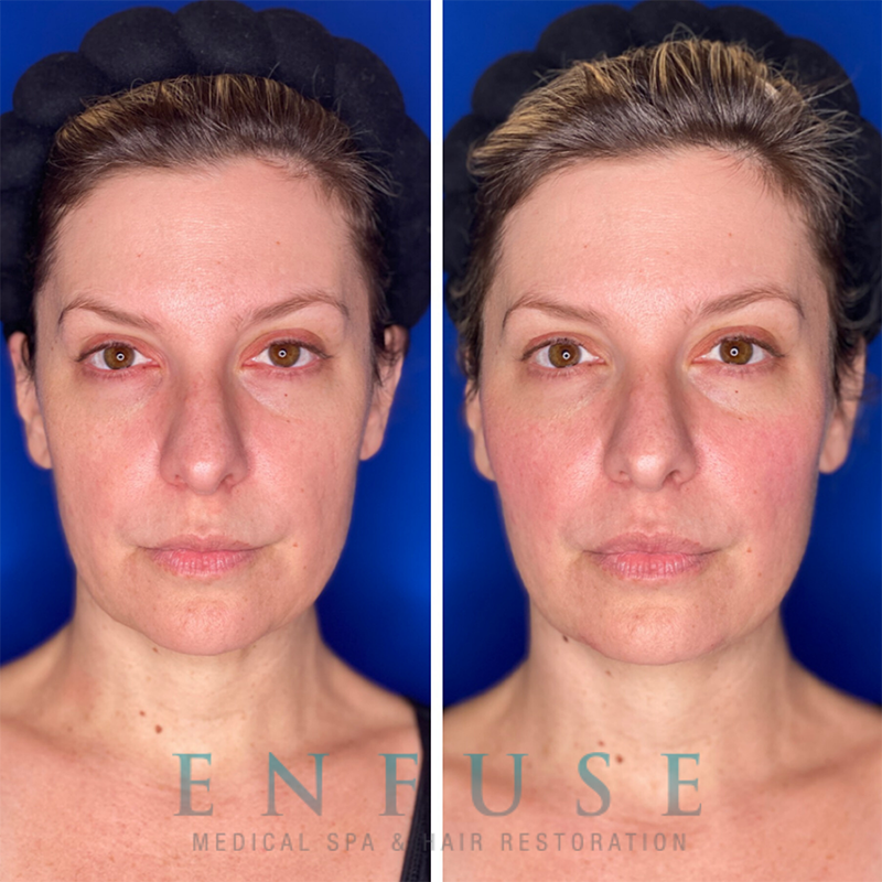 Injectable Filler