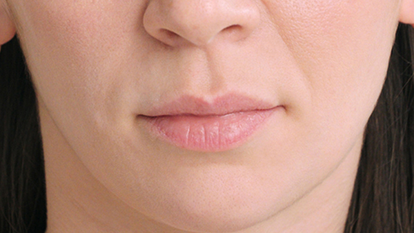 lip augmentation before