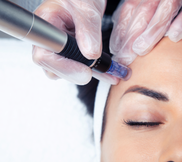 woman getting microneedling