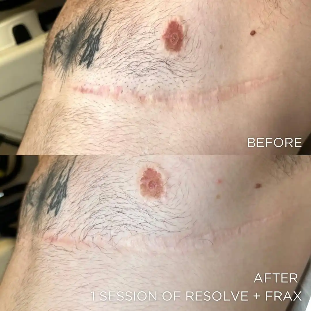 laser scar removal before and after photo