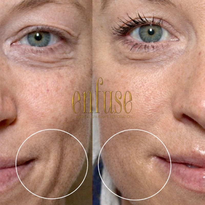 fractional laser resurfacing before and after
