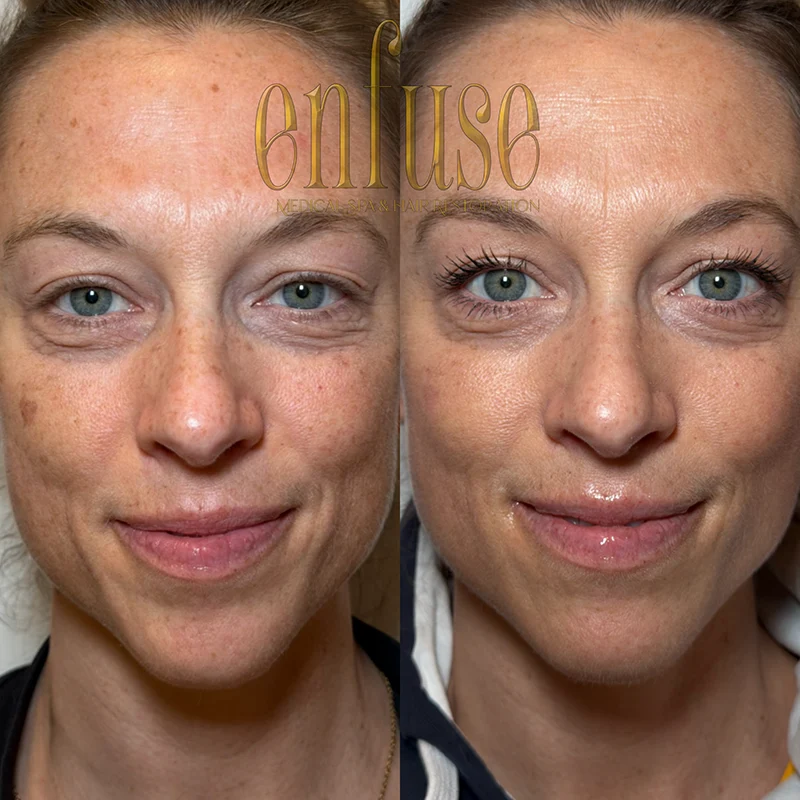 fractional laser resurfacing before and after
