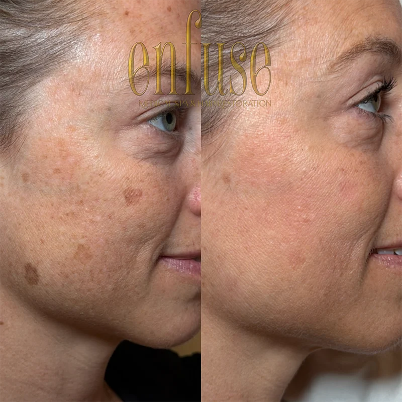 fractional laser resurfacing before and after