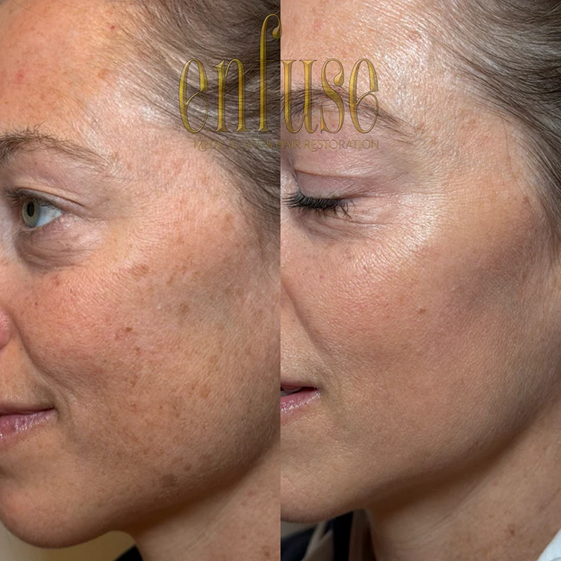 fractional laser resurfacing before and after
